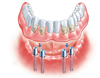 Применение покрывного протеза при отсутствии зубов