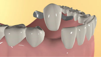 Методы протезирования без обточки зубов