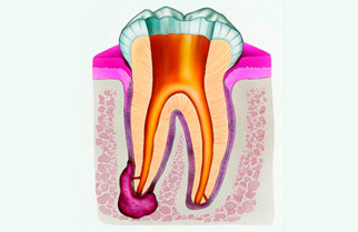 фото цистэктомии зуба