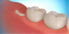 Выяснена природная восстановительная способность зубов.