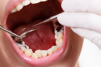 Кариес и стадии разрушения зуба