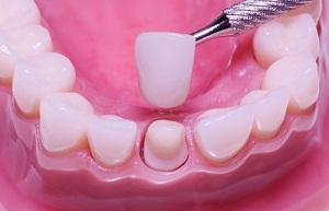 Восстановление коронки зуба.