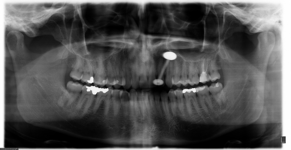 Рентгенограмма - диагностический инструмент, необходимый для составления стоматологического лечения