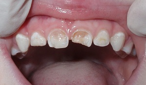 Восстановление переднего зуба.