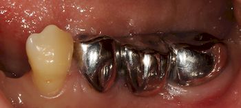 Особенности стальных коронок на зубы