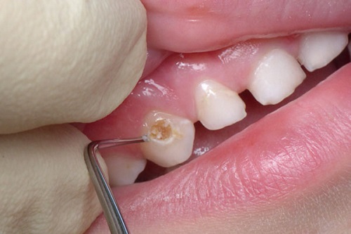 Как избавиться от кариеса в стадии пятна Удаление зубного камня Томск Красный